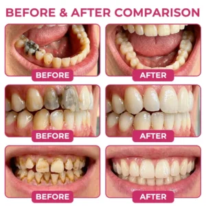 Tylsora® DenPerm Cavity-Repair Natural Enamel Filling Gel