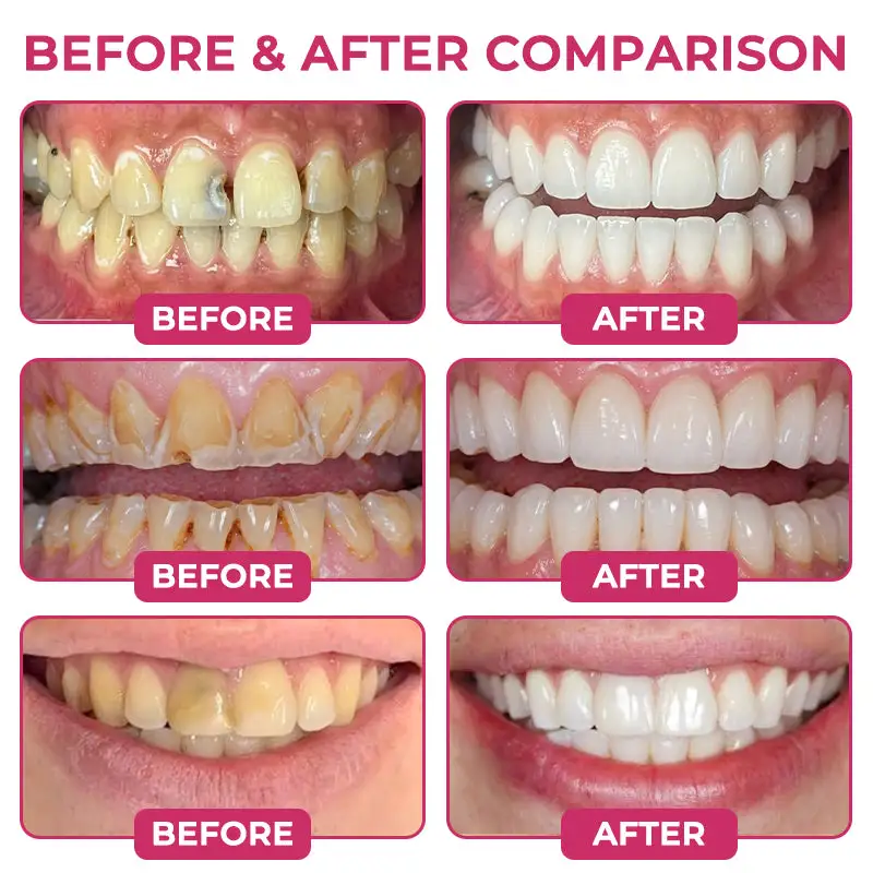 Tylsora® DenPerm Cavity-Repair Natural Enamel Filling Gel