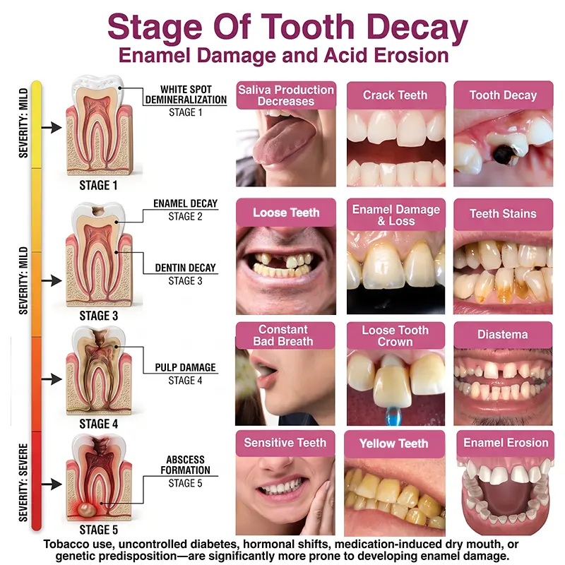 Tylsora® DenPerm Cavity-Repair Natural Enamel Filling Gel